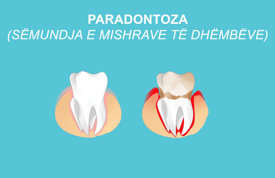 paradontoza