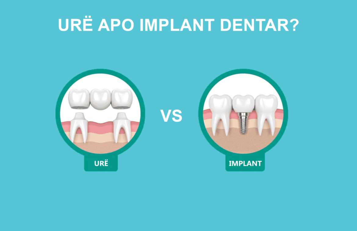 ure apo implant dentar