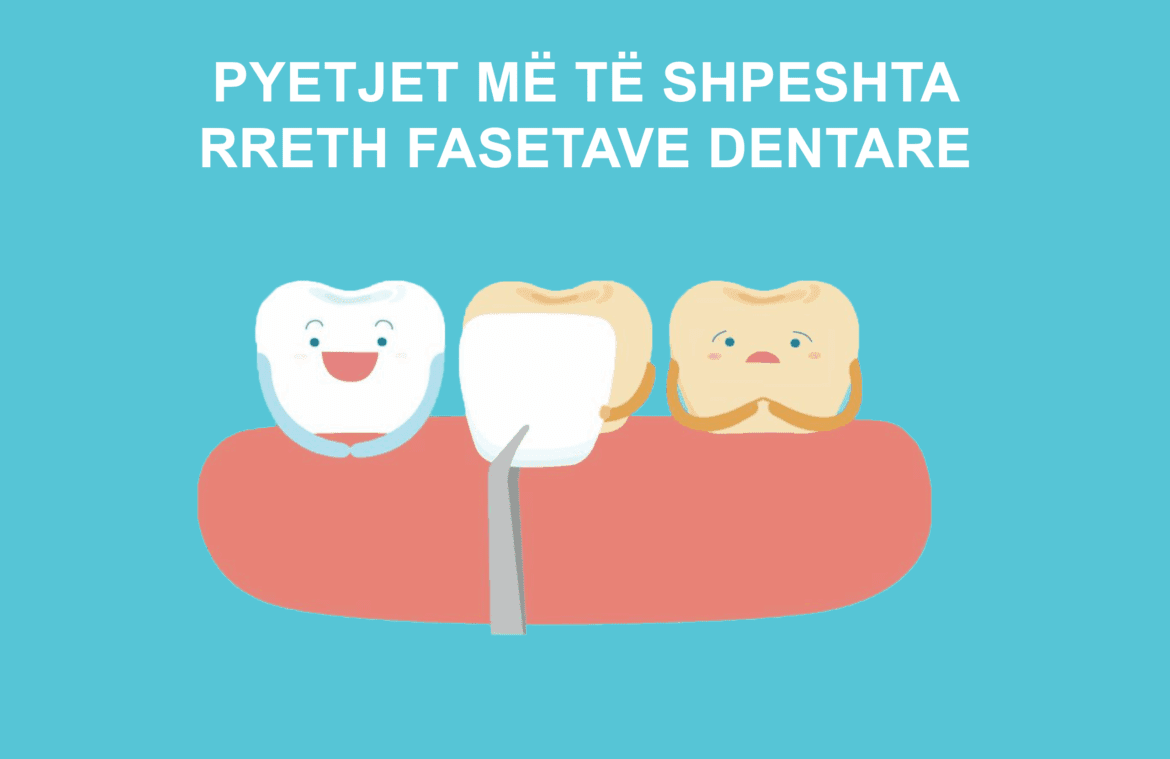 pyetje rreth fasetave dentare