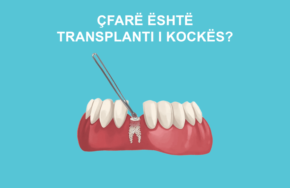 transplanti i kockes