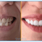 nga infeksione dentare tek kllefet dhe implantet