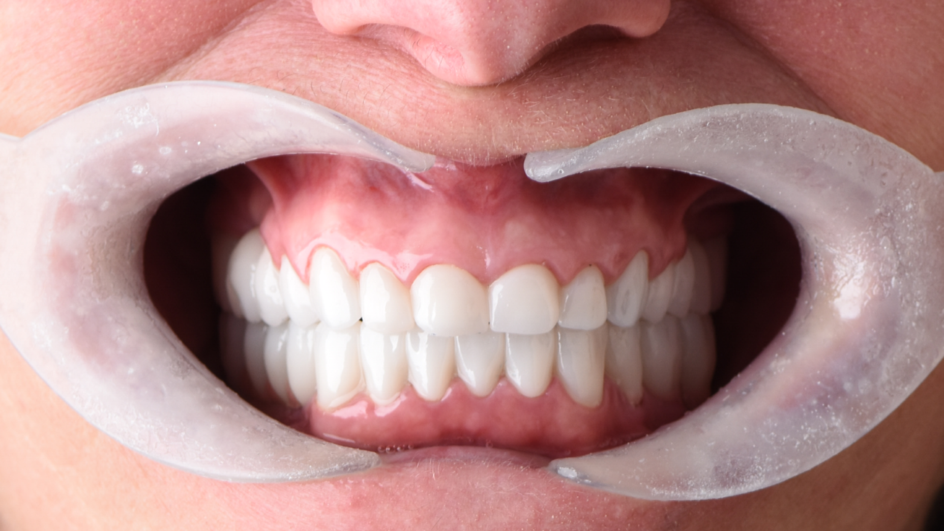 pas implanteve dentare