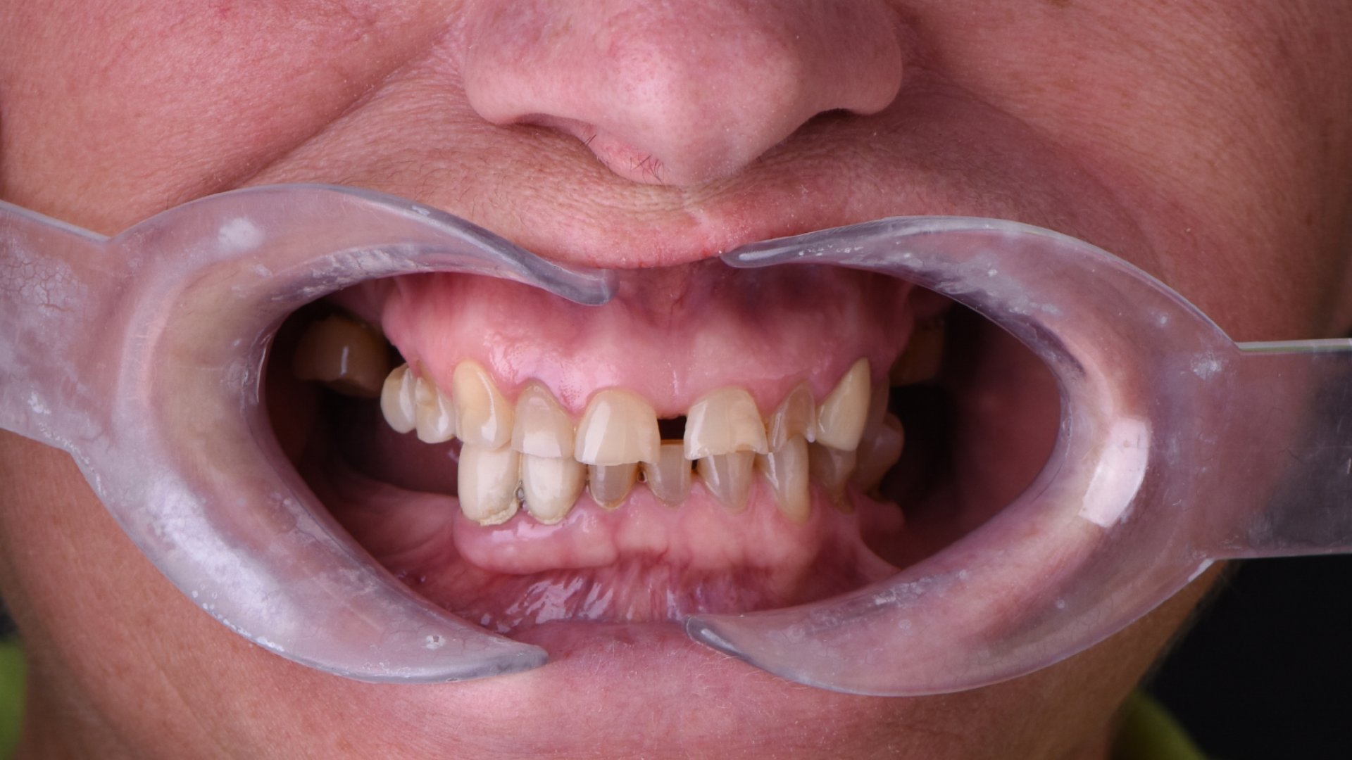 perpara implanteve dentare