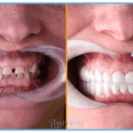 mungese dhemballeve te implantet dentare